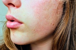 Allergie estive: sintomi e rimedi